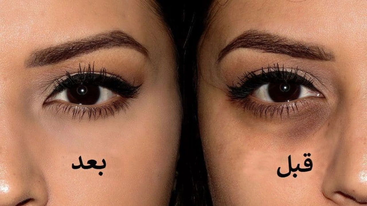 صورة تخلص من تجاعيد تحت العين