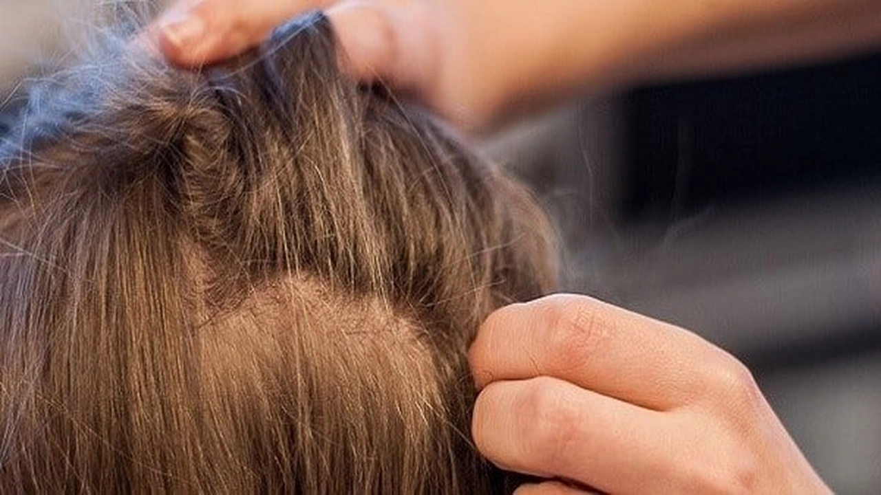 صورة تفسير حلم القمل في الشعر للمتزوجة