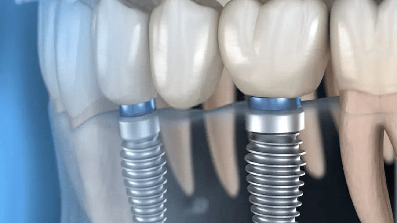 صورة زراعة الأسنان الفورية في الإمارات