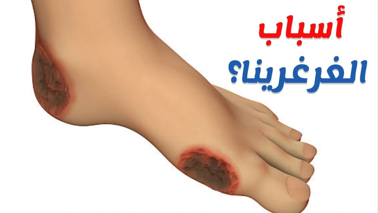 صورة شيء يسبب الغرغرينا