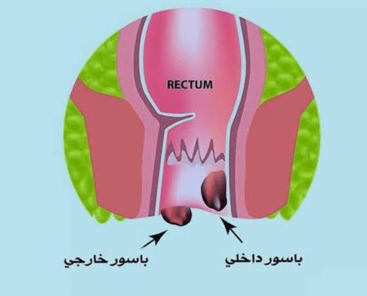 علاج البواسير بالثوم