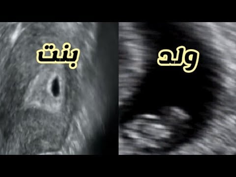 علامات البنت في السونار