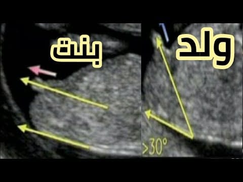علامات البنت في السونار