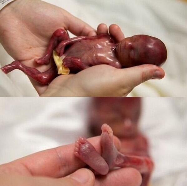 كيف اعرف أن الجنين ميت في الشهر الرابع