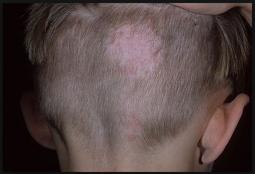 كيف اعرف انها ثعلبه