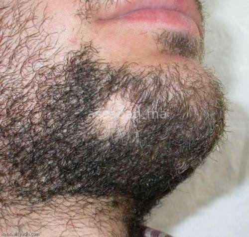 كيف اعرف انها ثعلبه