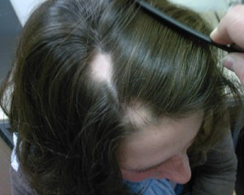 كيف اعرف انها ثعلبه