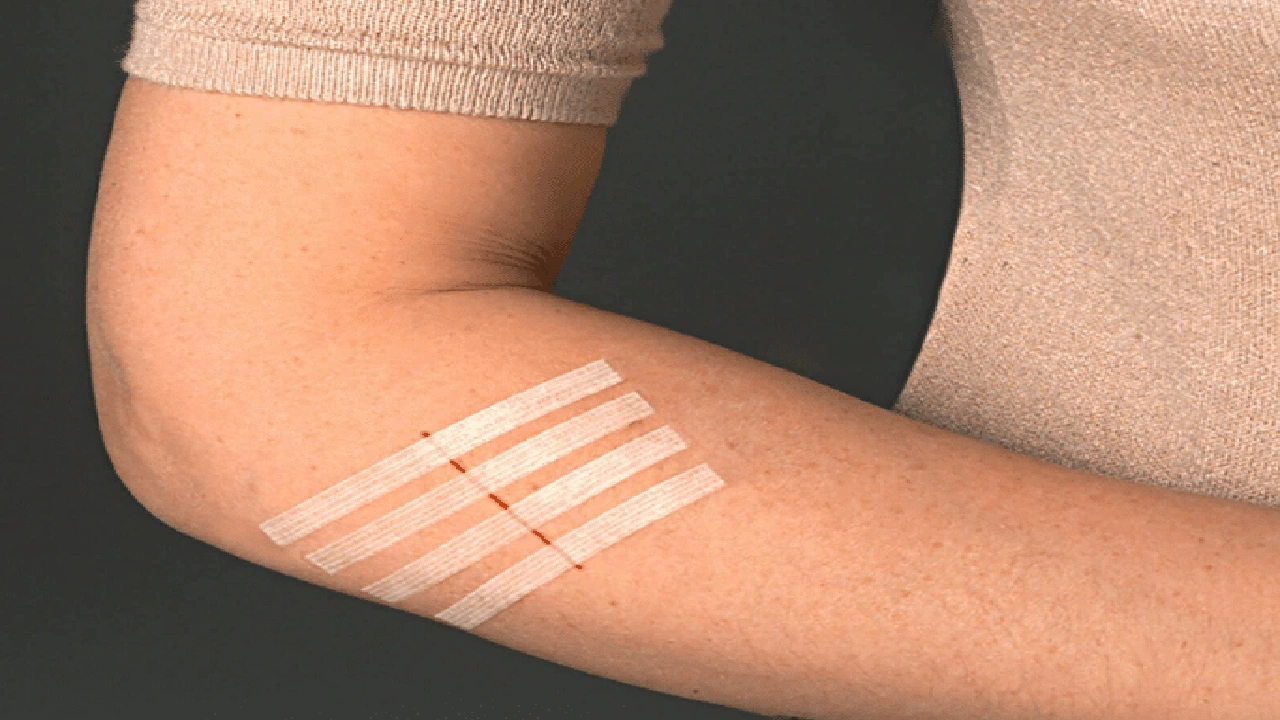 صورة كيفية استخدام steri strip