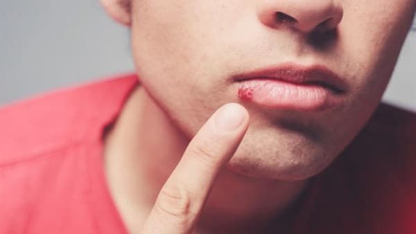متى تظهر أعراض الإيدز في الفم
