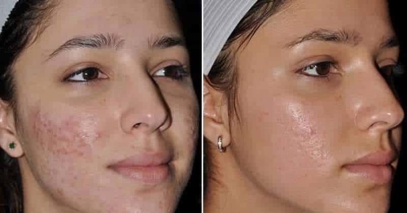 متى تظهر نتيجة الديرما رولر
