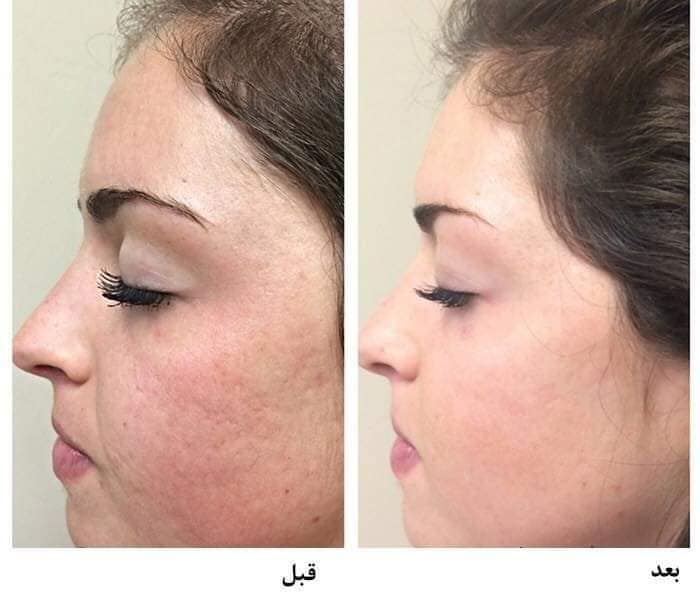 متى تظهر نتيجة الديرما رولر