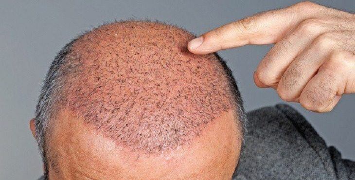 متى تظهر نتيجة زراعة الشعر