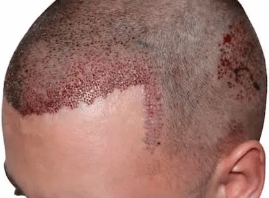 متى تظهر نتيجة زراعة الشعر