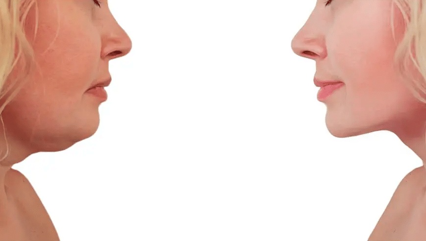 متى تظهر نتيجة شفط الذقن المزدوج