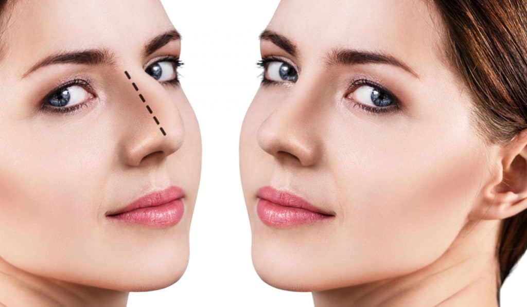 متى تظهر نتيجة عملية تجميل الأنف
