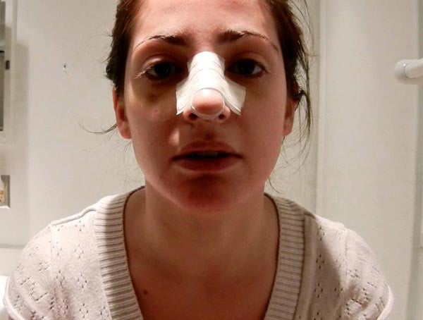 متى تظهر نتيجة عملية تجميل الأنف
