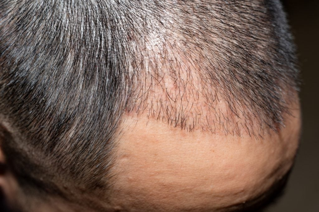 متى تظهر نتيجة عملية زراعة الشعر