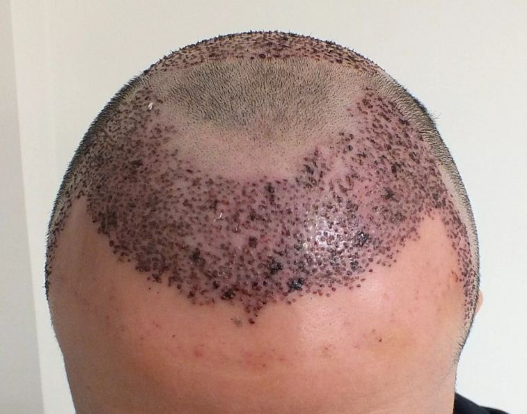 متى تظهر نتيجة عملية زراعة الشعر