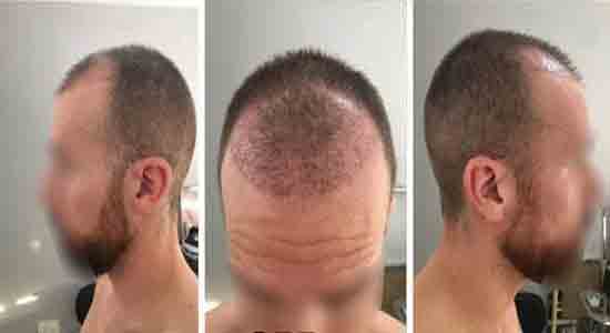 متى تظهر نتيجة عملية زراعة الشعر