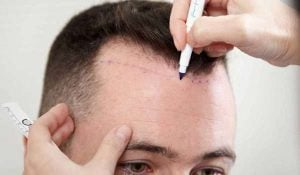 متى تظهر نتيجة عملية زراعة الشعر