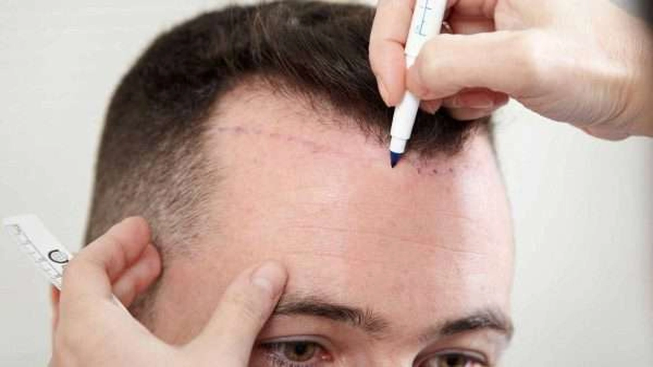 صورة متى تظهر نتيجة عملية زراعة الشعر