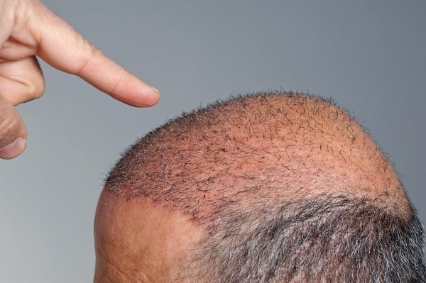 متى تظهر نتيجة عملية زراعة الشعر