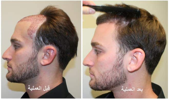 متى تظهر نتيجة عملية زراعة الشعر