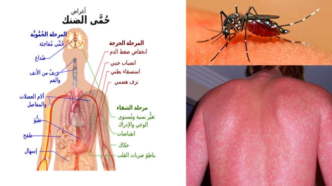 مطويات عن حمى الضنك