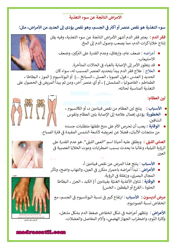 مطويات عن سوء التغذية