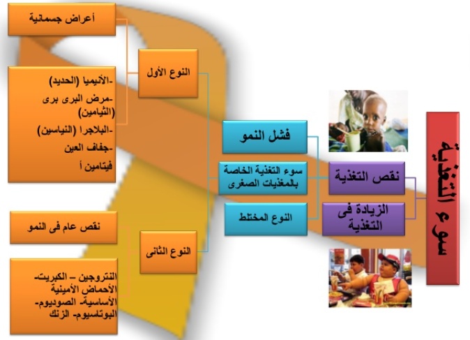 مطويات عن سوء التغذية