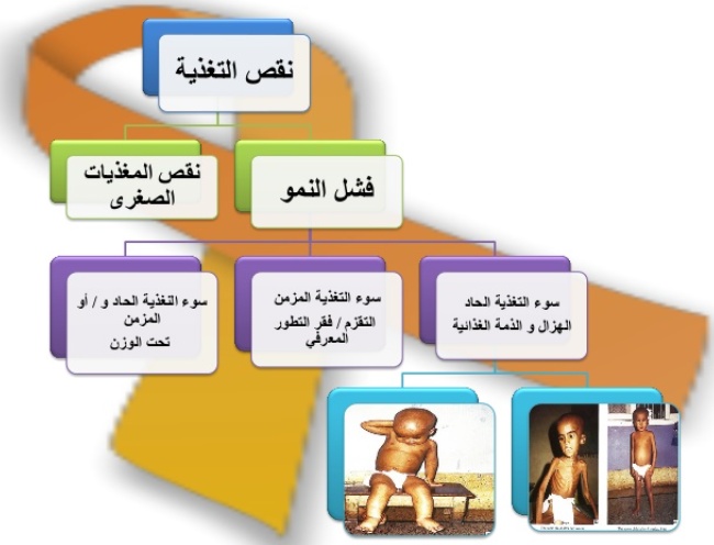 مطويات عن سوء التغذية