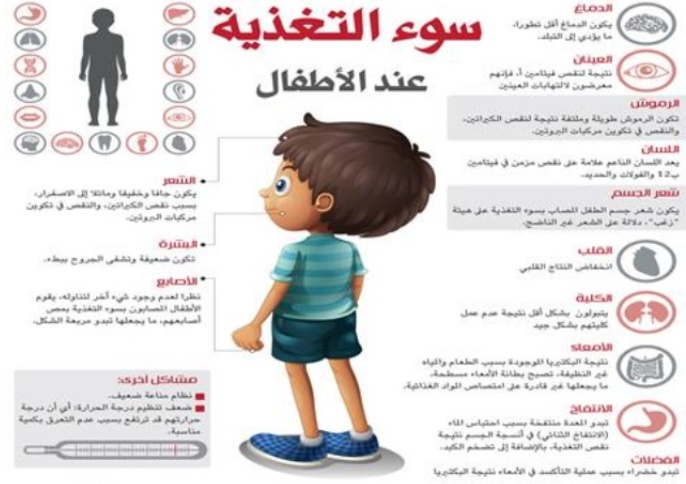 مطويات عن سوء التغذية