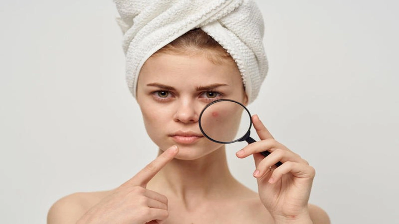 صورة معتقدات سائدة حول حب الشباب