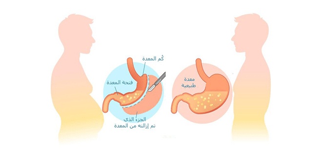 معلومات عن عملية التكميم