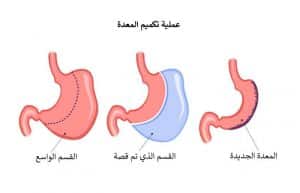معلومات عن عملية التكميم