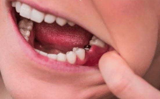 مميزات وعيوب زرع الاسنان