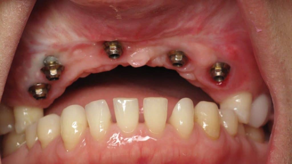 مميزات وعيوب زرع الاسنان