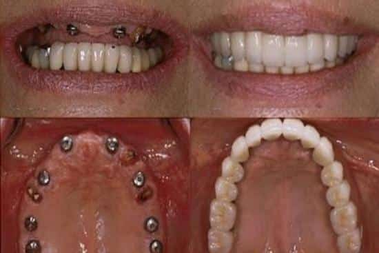 مميزات وعيوب زرع الاسنان