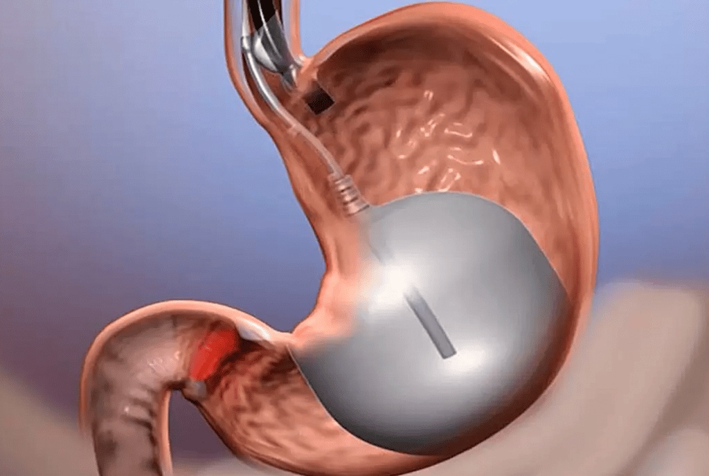 مميزات وعيوب عملية بالون المعدة