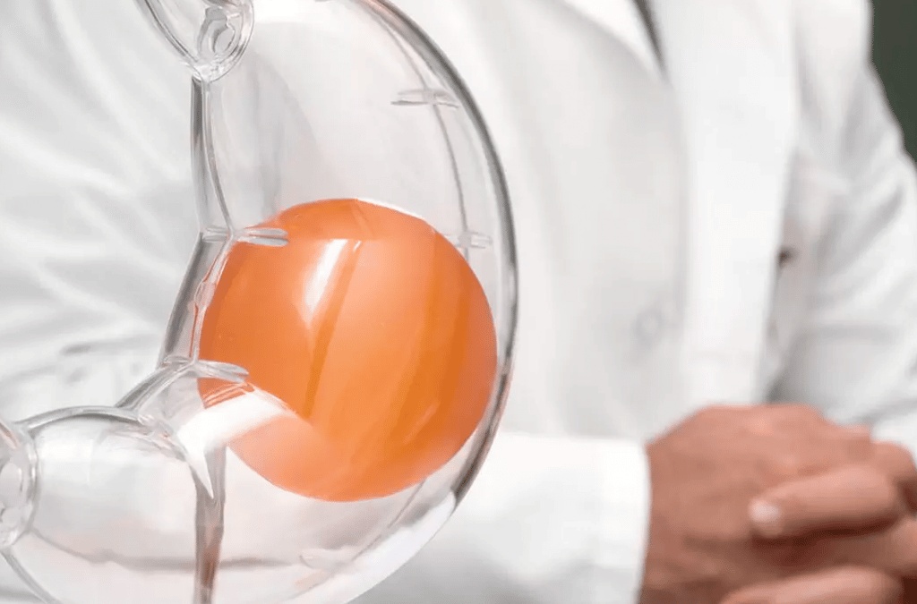 مميزات وعيوب عملية بالون المعدة