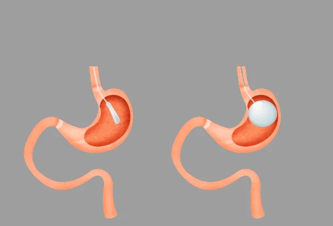 مميزات وعيوب عملية بالون المعدة