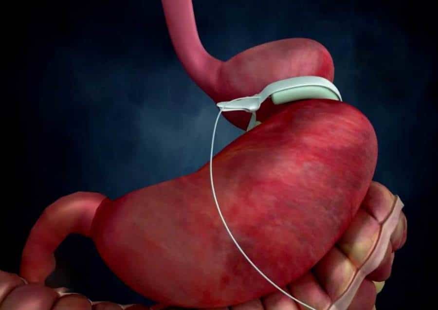 مميزات وعيوب عملية تكميم المعدة