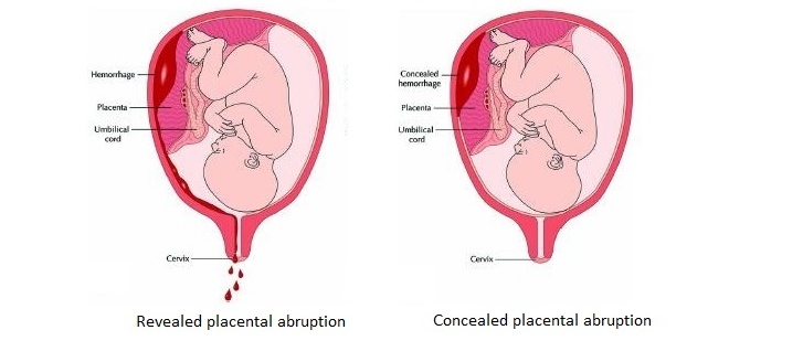 مين صار معها انفصال في المشيمة