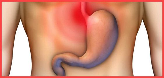 نصائح لعلاج ارتجاع المرئ