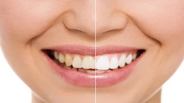 وصفة سحرية لعلاج اصفرار الأسنان